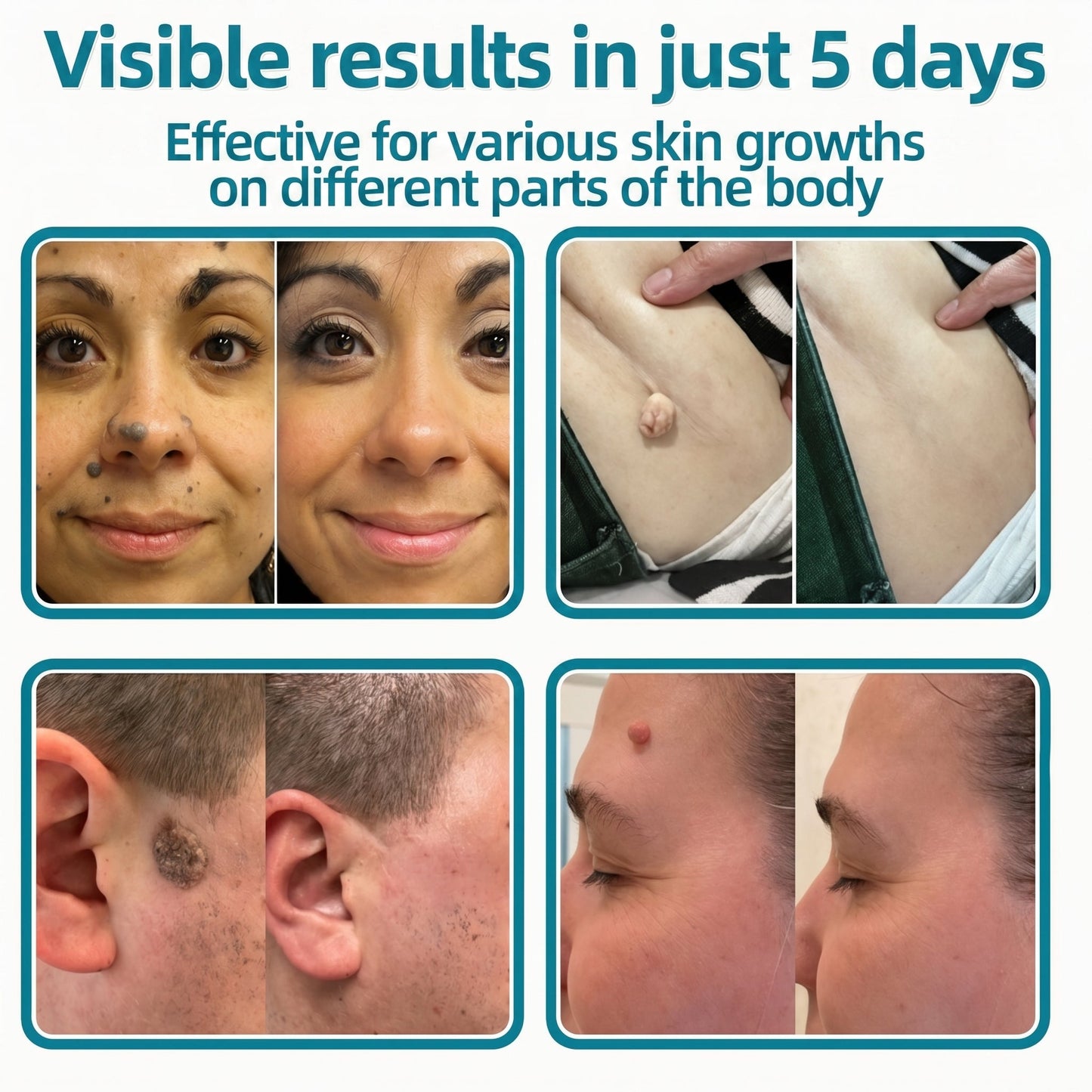 ✅🇺🇸𝐇𝐞𝒂𝒍𝗿𝗶𝙯𝙚®2-in-1 Microneedle & Hydrocolloid Patch👩‍⚕️| Removes Raised Moles, Acne, Flat Warts & Skin Tags | Helps Improve Wrinkles, Scars & Blemishes | Invisible Patches for Face & Body