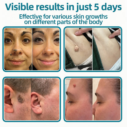 ✅🇺🇸𝐇𝐞𝒂𝒍𝗿𝗶𝙯𝙚®2-in-1 Microneedle & Hydrocolloid Patch👩‍⚕️| Removes Raised Moles, Acne, Flat Warts & Skin Tags | Helps Improve Wrinkles, Scars & Blemishes | Invisible Patches for Face & Body
