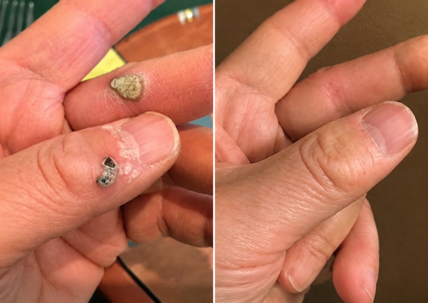 ✅🇺🇸𝐇𝐞𝒂𝒍𝗿𝗶𝙯𝙚®2-in-1 Microneedle & Hydrocolloid Patch👩‍⚕️| Removes Raised Moles, Acne, Flat Warts & Skin Tags | Helps Improve Wrinkles, Scars & Blemishes | Invisible Patches for Face & Body