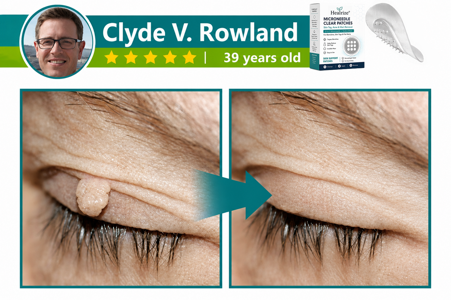 ✅🇺🇸𝐇𝐞𝒂𝒍𝗿𝗶𝙯𝙚®2-in-1 Microneedle & Hydrocolloid Patch👩‍⚕️| Removes Raised Moles, Acne, Flat Warts & Skin Tags | Helps Improve Wrinkles, Scars & Blemishes | Invisible Patches for Face & Body
