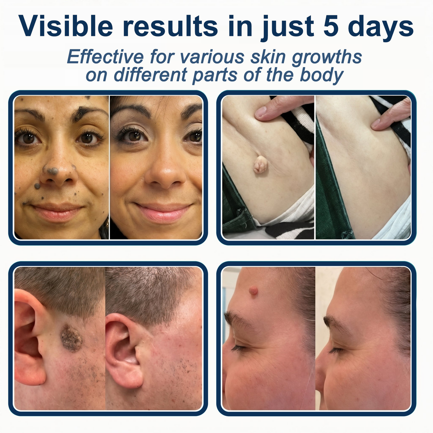 ✅🇺🇸𝐇𝐞𝒂𝒍𝗿𝗶𝙯𝙚®2-in-1 Microneedle & Hydrocolloid Patch💫| Removes Raised Moles, Acne, Flat Warts & Skin Tags | Helps Improve Wrinkles, Scars & Blemishes | Invisible Patches for Face & Body
